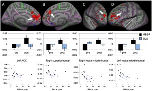 Functional connectivity between the seed region in the right amygdala and several regions in the frontal cortex increased from pre- to post-intervention in GAD patients who underwent the MBSR program (N = 15), but not in those who underwent the SME class (N = 11). Anatomical location displayed on an inflated surface with FreeSurfer cortex parcellations (top row), regression coefficients extracted from the clusters from the MBSR (black) and SME (blue) participants at pre- and post-interventions (middle row) and scatter plots of regression coefficients (y-axis) and Beck Anxiety Inventory (BAI, x-axis) for MBSR and SME participants at post (bottom row) for the left rostral anterior cingulate cortex (ACC, column A, pre- to post increase in connectivity: p = 0.0002, multiple comparison corrections within mask of the frontal cortex/insula; correlation with BAI scores: ρ = − .229, ns, uncorrected), right superior frontal cortex (column B, pre–post increase: p = 0.04; correlation: ρ = − .470, p = .015), right rostral middle frontal cortex (column C, pre–post increase: p = 0.03; correlation: ρ = − .572, p = .002), and left rostral middle frontal cortex (column D, pre–post increase: p = 0.01; correlation: ρ = − .646, p < .001).